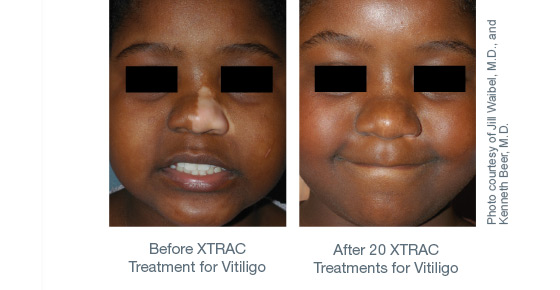 Before and After XTRAC Treatments