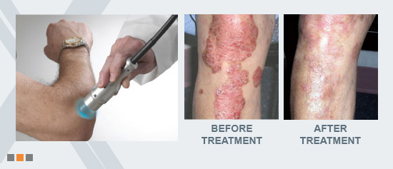 xtrac psoriasis treatment side effects