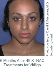 6 Months After 48 XTRAC Treatment for Vitiligo