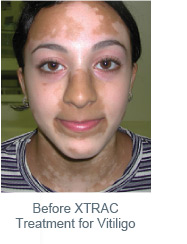Before XTRAC Treatment for Vitiligo
